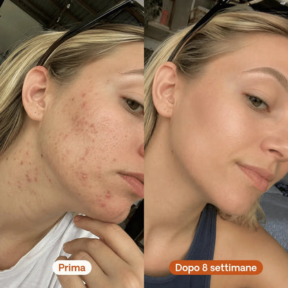 Stick Riparatore per Cicatrici da Acne