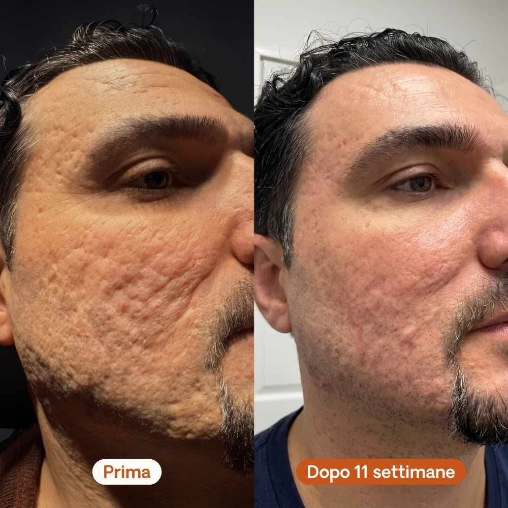 Stick Riparatore per Cicatrici da Acne