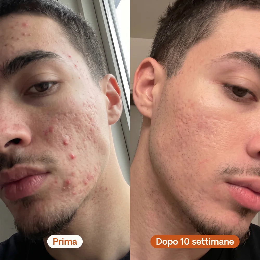 Stick Riparatore per Cicatrici da Acne